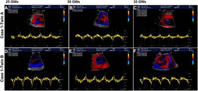 Case Report: Prenatal Diagnosis and Treatment of Fetal Autoimmune-Associated First-Degree Atrioventricular Block: First Report From China